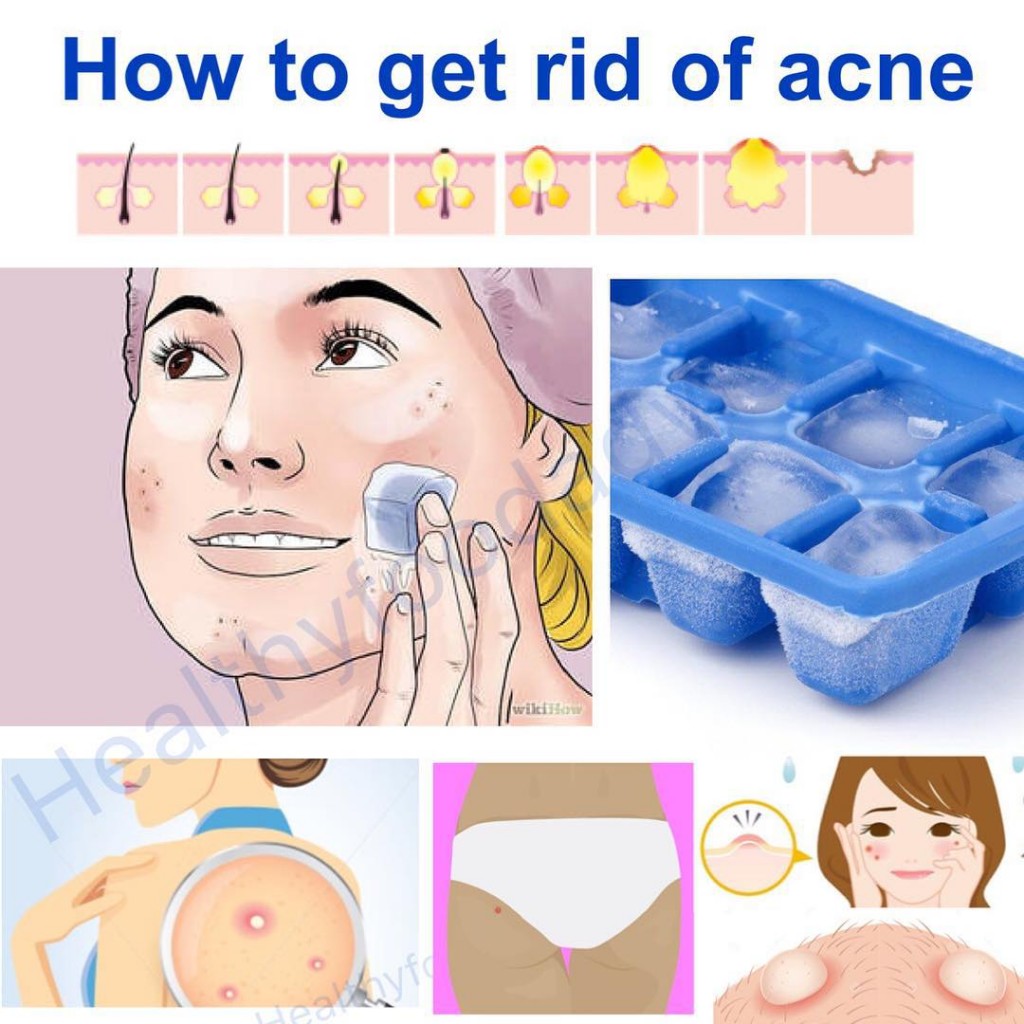 How to Get Rid of Acne in 12 Hours | Healthy Fitness Recipe