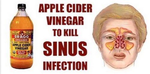 How To Kill Sinus Infection Within Minutes With Apple Cider Vinegar!
