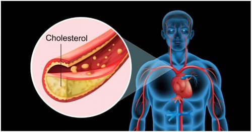 Cholesterol: What causes high cholesterol ? Is diet the real cause ?